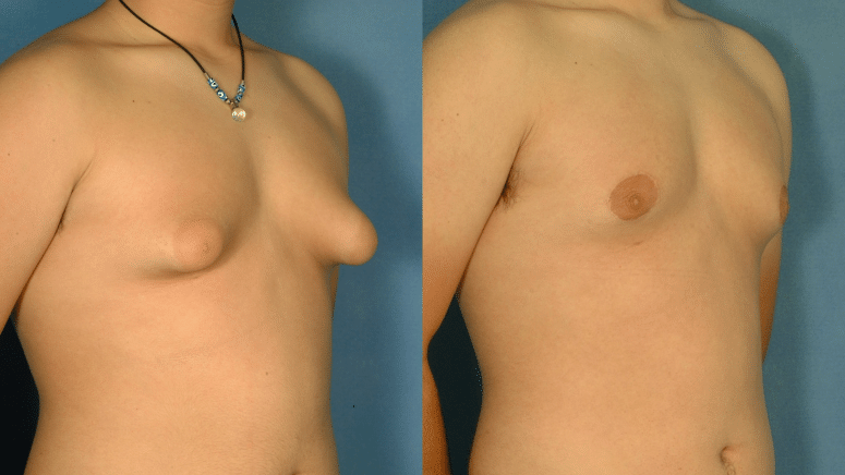 before and after image of man with Gynecomastia, male nipple