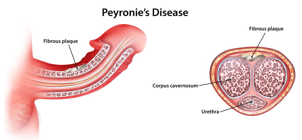 peyronie's disease