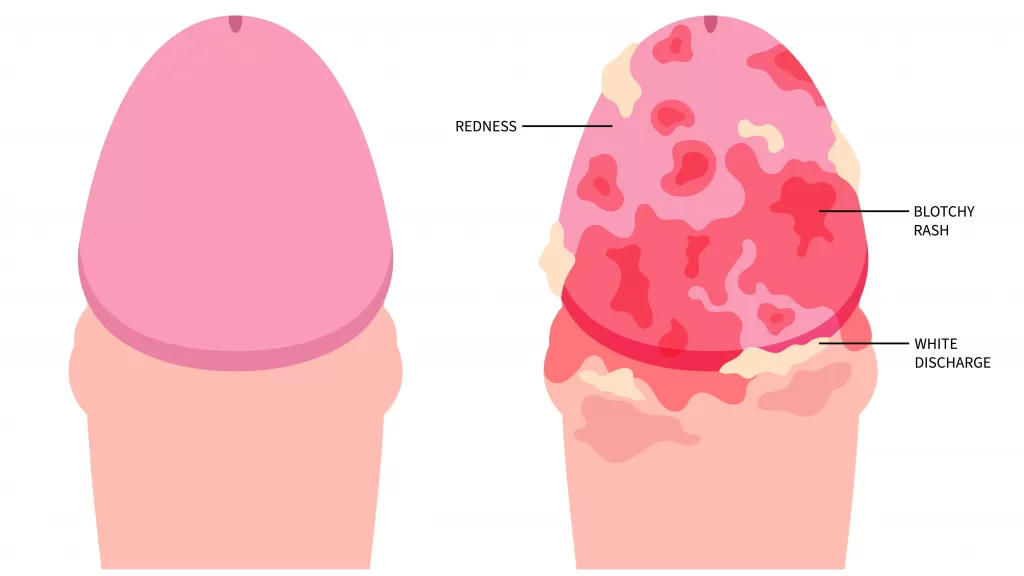 understanding Genital buildup, balanitis and smegma